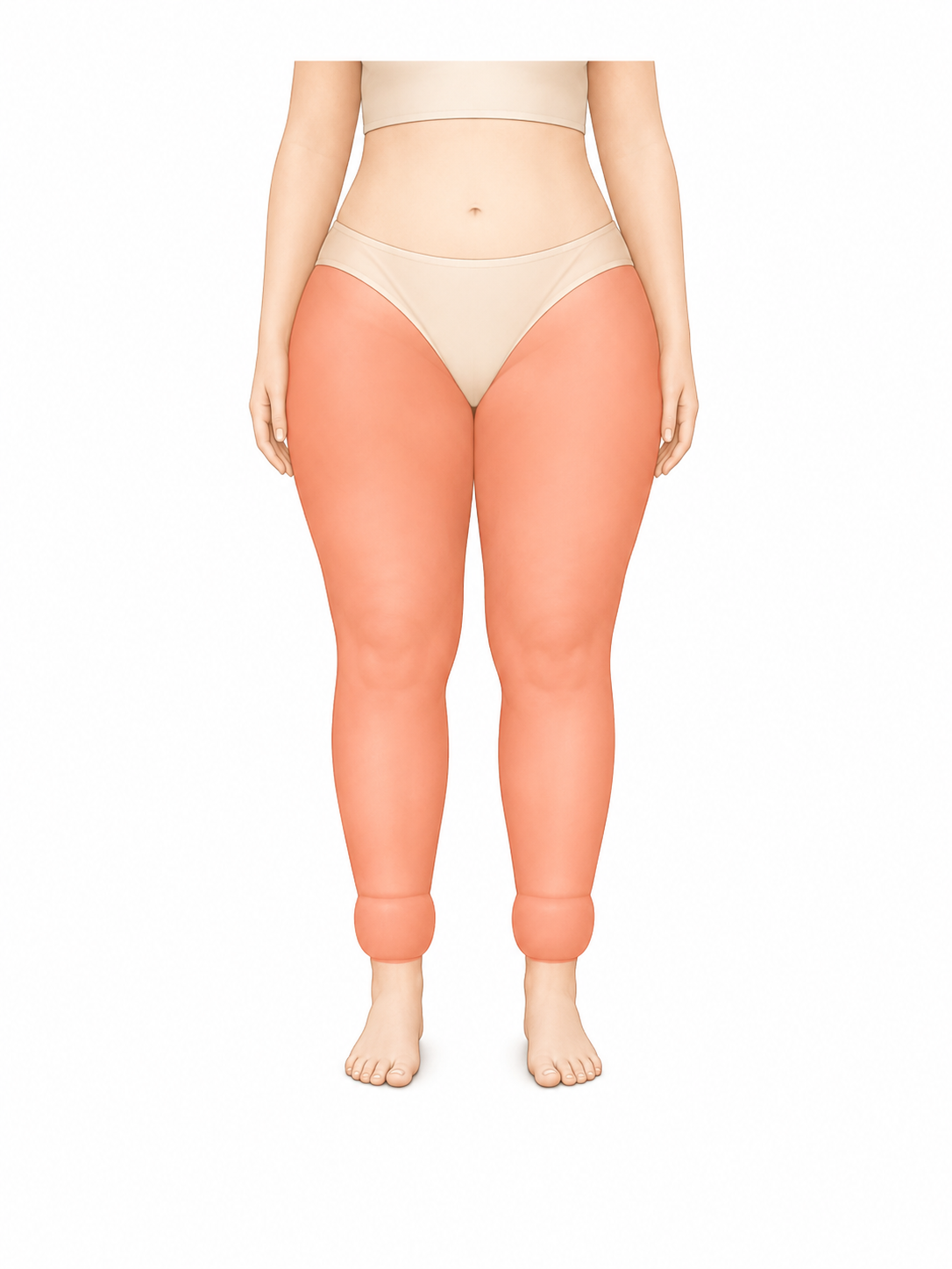 Lipedema tipo III dos quadris aos tornozelos
