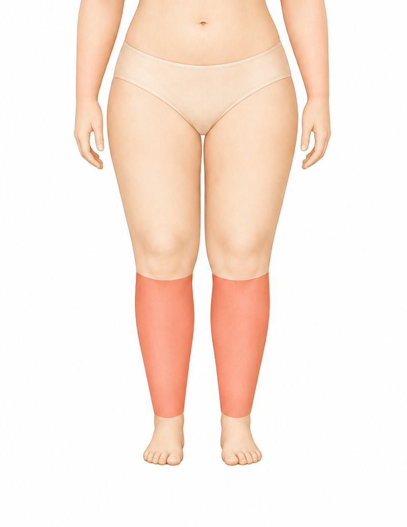 Lipedema tipo V abaixo dos joelhos
